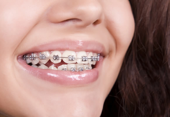 Get your braces at Dakota Orthodontics in Fargo, North Dakota.